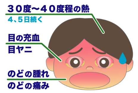咽頭結膜熱の症状